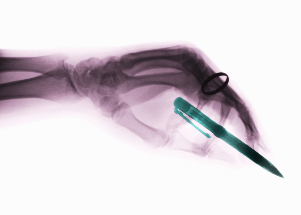 X-Ray Hand and Pen