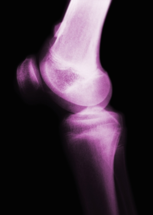 Knee X-Ray