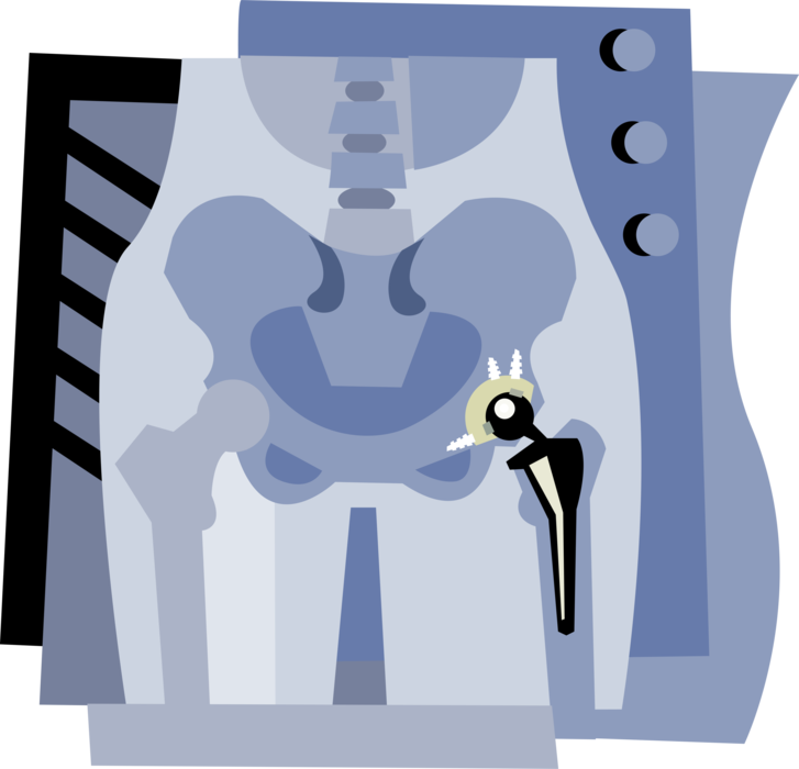 Vector Illustration of Artificial Hip Replacement Joint Hardware on Hospital X-Ray